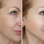 The Latest Innovations in Skin Resurfacing&nbsp;Techniques